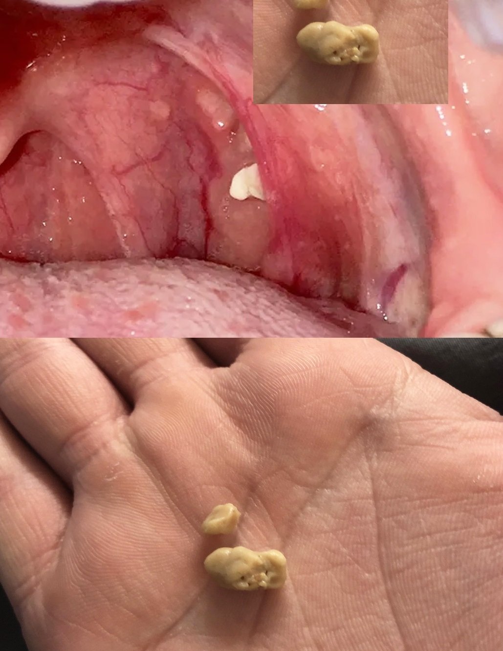 Why do we have white lumps in our throat? 25 493084619 122167449398480977 8257324858791289787 n