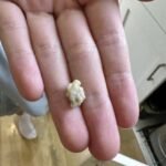 tout ce que vous devez savoir sur les calculs amygdaliens