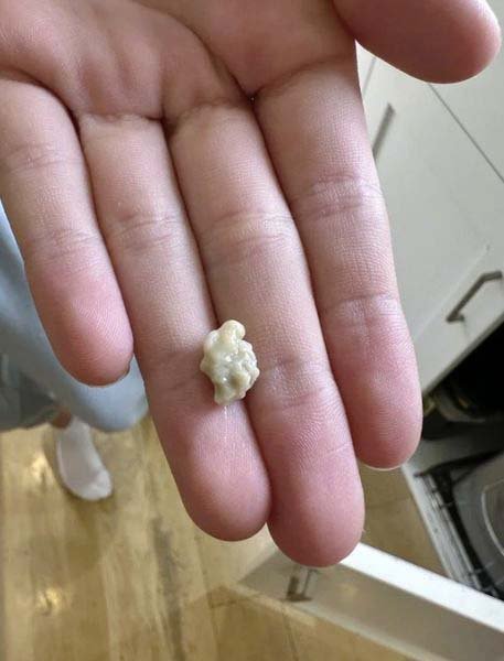 tout ce que vous devez savoir sur les calculs amygdaliens